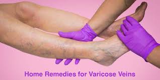 home remes for varicose veins