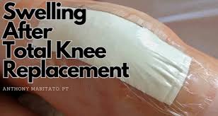 swelling after knee replacement