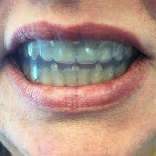 Your orthodontist may specific that you continue to wear a retainer for a number of months, or more permanently, to ensure your teeth stay in their correct alignment long term. Perfect Your Bite With A Tooth Positioner