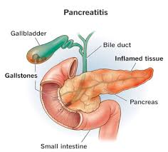 acute pancreais the nutrition care