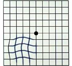 Amsler Grid As Viewed By A Person With Early Stages Of