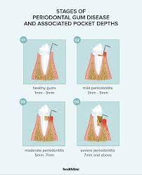 periodontal pockets severity risk
