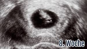 Mit dem kind ist soweit alles in ordnung, das herzchen. 8 Ssw Die 8 Schwangerschaftswoche Ultraschall Symptome Tipps Netmoms De