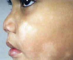 treatment of white patches on face