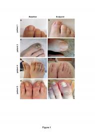 topical treatment for onychomycosis