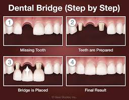 dental bridges vs dental implants