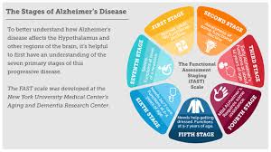 How Alzheimers Disease Changes The Brain My Moment