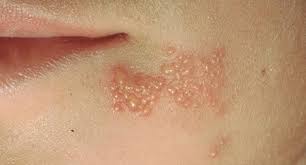 herpes simplex