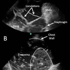 Obliteration of left costophrenic angle with a wide pleural based dome shaped opacity projecting into. A Loculated Pleural Effusion A Complex Pleural Effusion Is Shown With Download Scientific Diagram