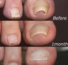 ingrown toenail surgery during the busy