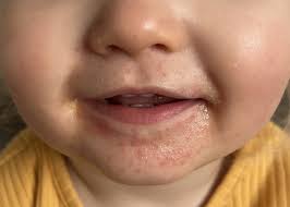 rash around toddlers mouth mumsnet