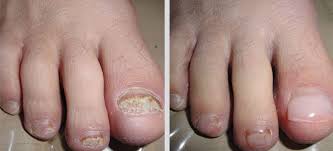 acrylic nails on toenails keryflex