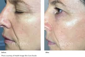 Before and after photos and results. What Is Microneedling Mdpen Latest Innovation In Skin Care