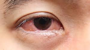 eye infections raffles eye centre