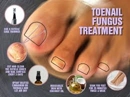best toenail fungus treatment with