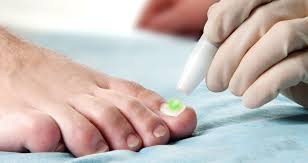 fungal nail five possible causes for