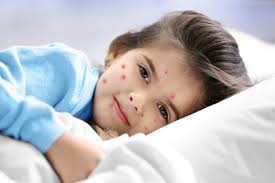 Chickenpox in Children – Symptoms, Treatment & Home Remedies ~ Epic Health