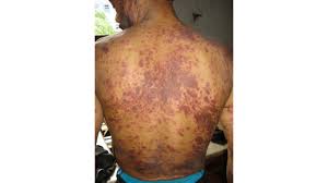 hiv rash what does it look like and