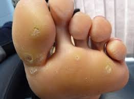 They appear to be disfigured and sore and appear to be small black spots in the early stages. Plantar Warts Eradicate The Colony Katherine J Scott