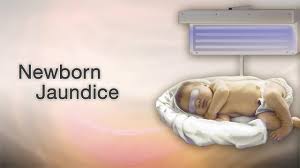 newborn jaundice information mount