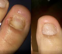 Toenail fungus affects millions of people in the united states. I Ve Struggled With Fungus For 4 Years I Tried Everything From Lamisil Cream Otc Products That You Put On Like Nail Polish And Tea Tree Oil None Of Those Worked I Started