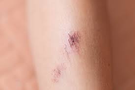 scabs what they are and how they heal