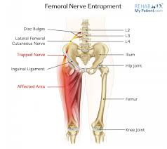fem nerve entrapment rehab my patient