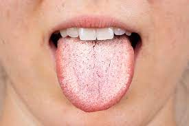 11 reasons for a white tongue treatments