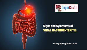 symptoms of viral gastroenteritis