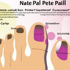 nail patella syndrome types causes
