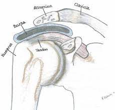 The morphology of the acromion and its relationship to rotator cuff tears. Impingement Syndrome Corporate