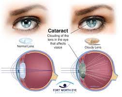 cataract surgery procedure safety