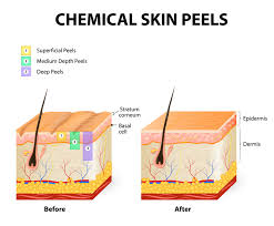 Https Www Theperfectdermapeel Com Which Type Of Chemical