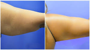 arm liposuction chicago chicago