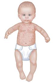 Roseola is infectious before the rash is visible and it can take five days to 15 days. Roseola When Your Child Has