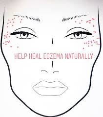 natural remes for eczema around