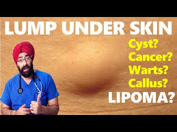 lump under skin lipoma cysts cancer