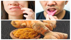 turmeric helps in treating mouth ulcers