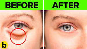 remes to get rid of under eye bags