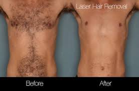 lightsheer diode laser hair removal in