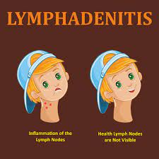 enlarged lymph nodes or lymphadenitis