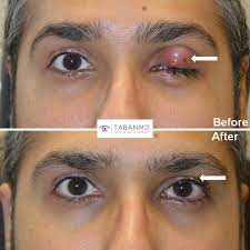 chalazion removal beverly hills stye