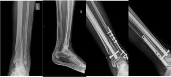 x rays of distal tibia fracture treated