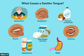 swollen tongue causes symptoms and