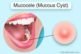 mucocele diagnosis treatment and
