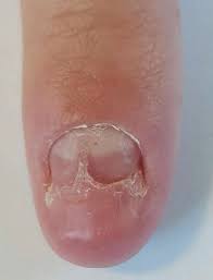 nail dystrophy in a young boy