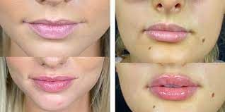lip injections offer more than just