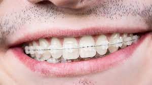 When the teeth erupt and grow in a way that they become overlapped, twisted, angled or rotated, they become crowded, crooked or misaligned. Crooked Teeth Causes Concerns And How To Straighten