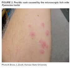 outbreak of pruritic rashes ociated